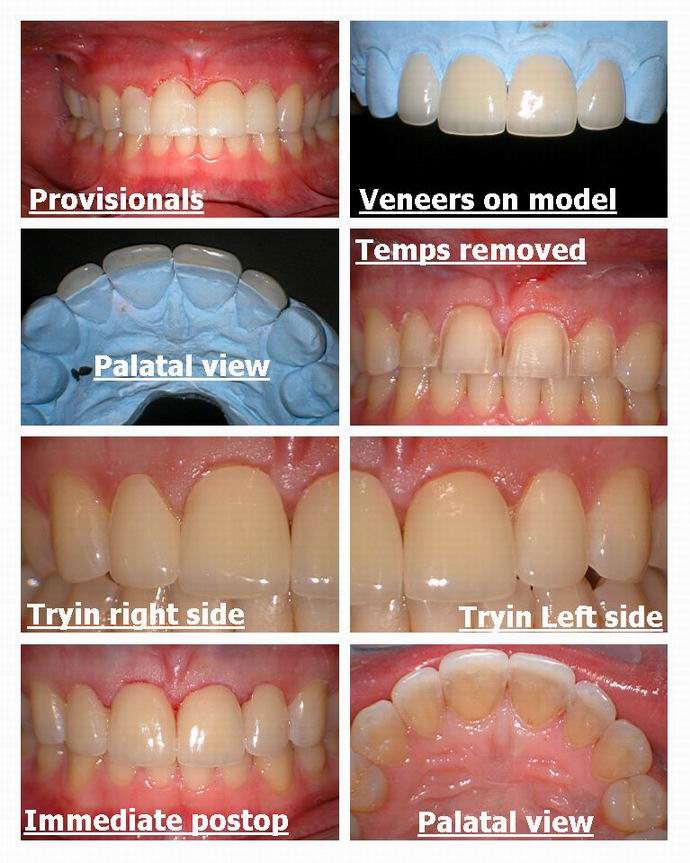 Resize of Veneers and lasers Act 2.jpg